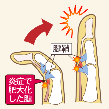 炎症で肥大化した腱
