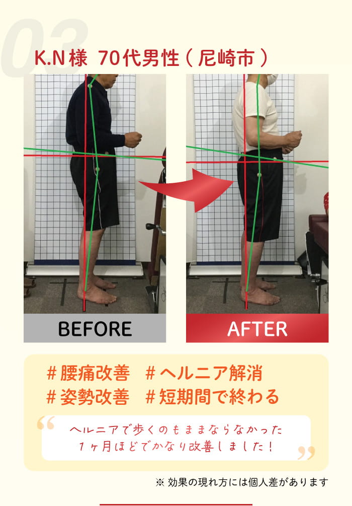 03：K. N 様 70 代男性(尼崎市) #腰痛改善 #ヘルニア解消 #姿勢改善 #短期間で終わる。ヘルニアで歩くのもままならなかったが7ヶ月はどでかなり改善しました! 